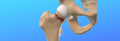 Zlomeniny krčku stehenní kosti: Vše, co potřebujete vědět