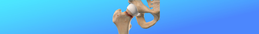 Zlomeniny krčku stehenní kosti: Vše, co potřebujete vědět